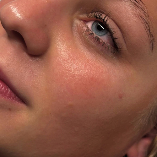 LED Light Therapy Add-On result